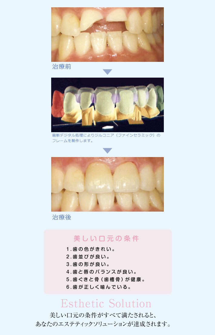 審美歯科治療前と後の写真