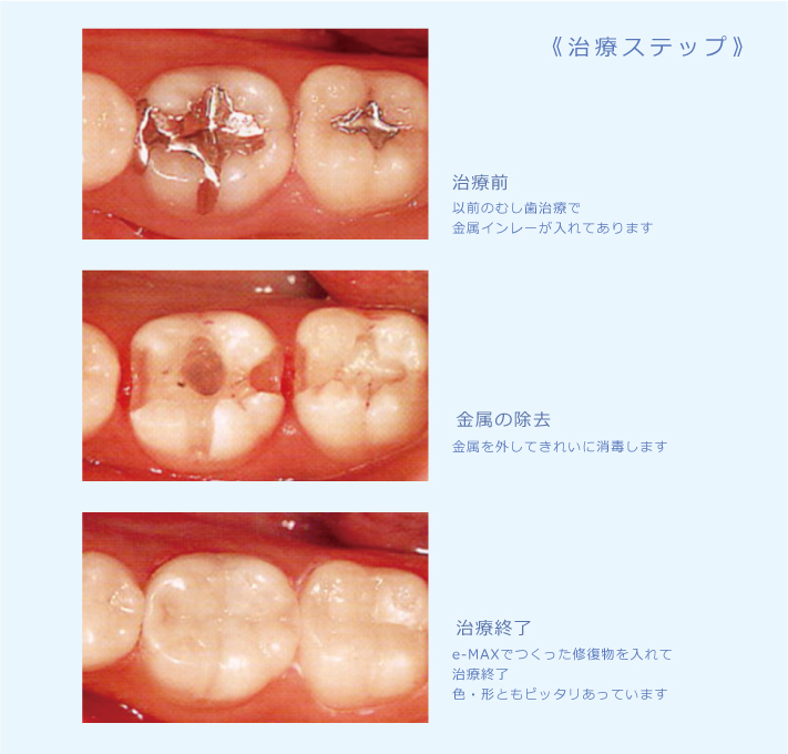 審美歯科治療のステップ写真