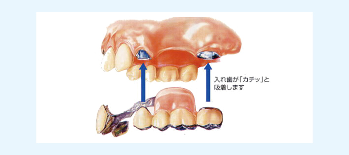 磁石方式の入れ歯の写真