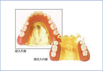 ゴールド義歯の写真
