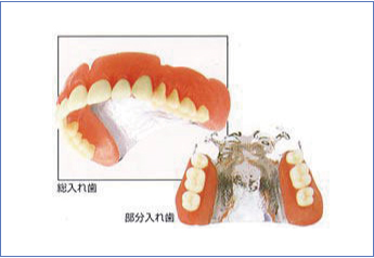 チタン義歯の写真
